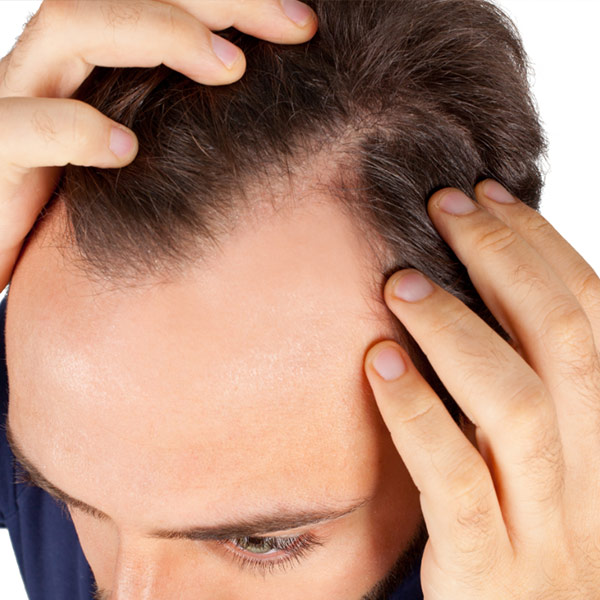 Perdita di capelli negli uomini: più diffusa nei fumatori